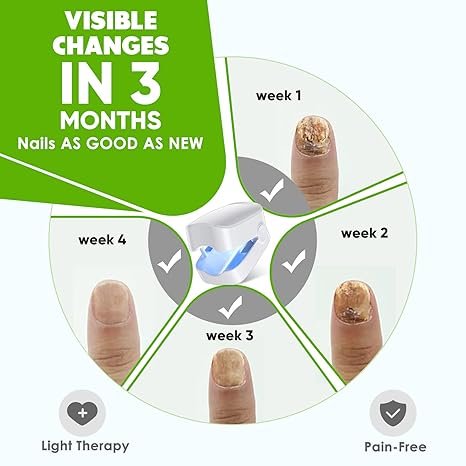 💡 Nail Fungus Light – Safe, Easy & Effective At-Home Solution for Healthier Nails 👣🧼🔵