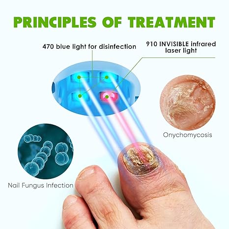 💡 Nail Fungus Light – Safe, Easy & Effective At-Home Solution for Healthier Nails 👣🧼🔵